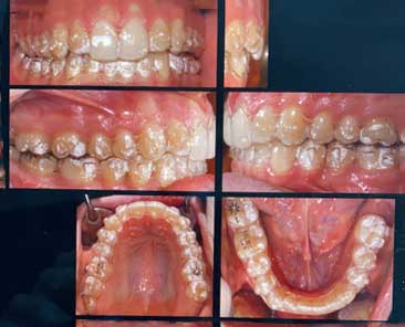 Ortodonzia-invisibile-2