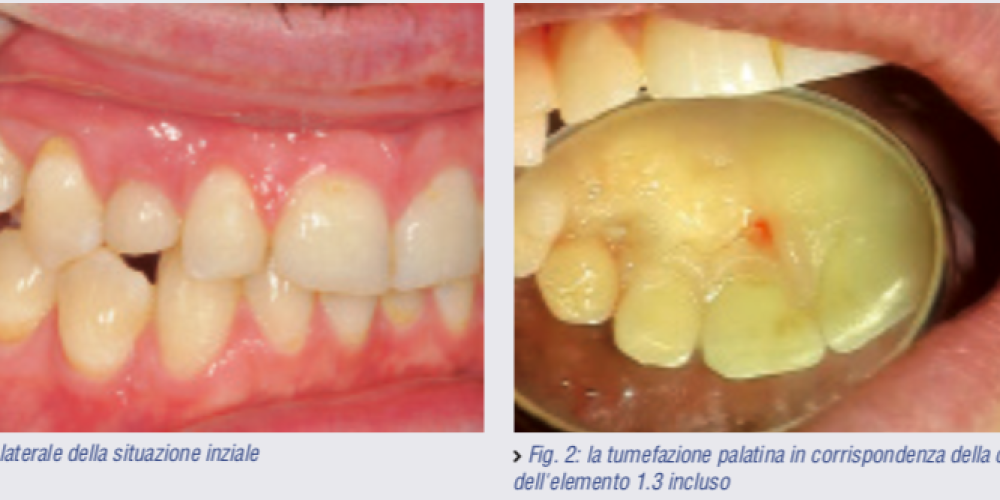 Preservazione alveolare e inserimento impianto canino incluso